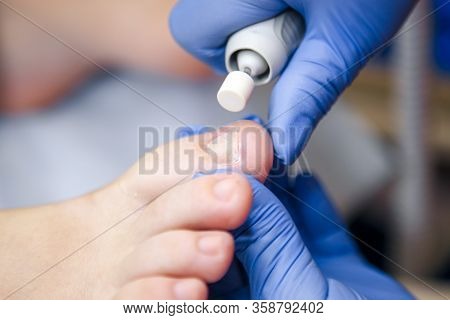 Podology Treatment. Podiatrist Treating Toenail Fungus. Doctor Removes Calluses, Corns And Treats In