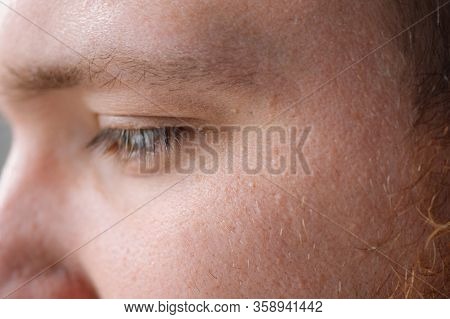 Milia (milium) - Pimples Around Eye On Skin. Eyes Of Young Man With Small Papillomas On Eyelids Or G