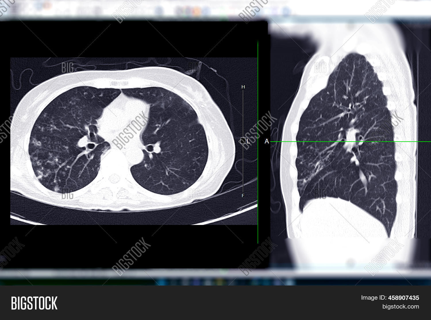Ct Chest Ct Scan Lung Image & Photo (Free Trial) Bigstock