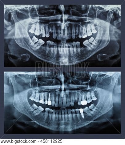 Orthopantomograph Panoramic Image Radiograph Of Teeth