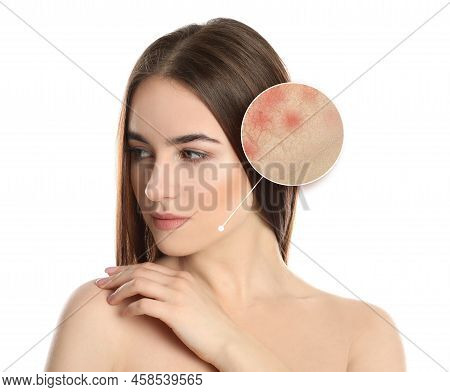 Young Woman With Facial Dry Skin Problem On White Background