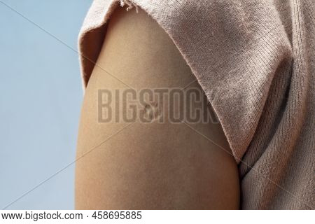Bacillus Calmette-guern Vaccine,  Bcg Or Tb Vaccine Scar Mark At The Arm Of Southeast Asian Women.