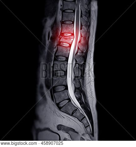Mri Of Lambosacral Spine Or L-s Spine On Sagittal Plane Showing Herniated Disc Of L-s Spine