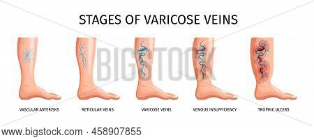 Stages Of Varicose Veins So As Vascular Asterisks Reticular Veins Venous Insufficiency Trophic Ulcer