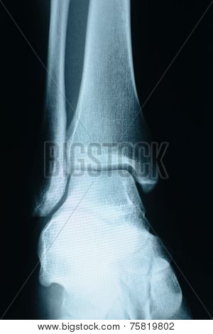 Heel Xray