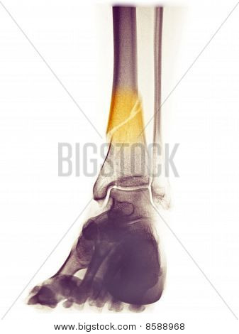 48 Yaşındaki kadın alt bacak X-ray bir Spiral kırık Distal Tibia ile