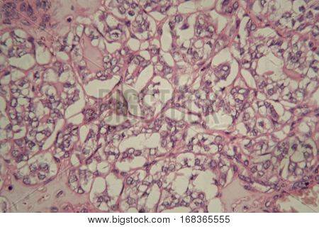 Human thyroid gland cells with cancer under the microscope.