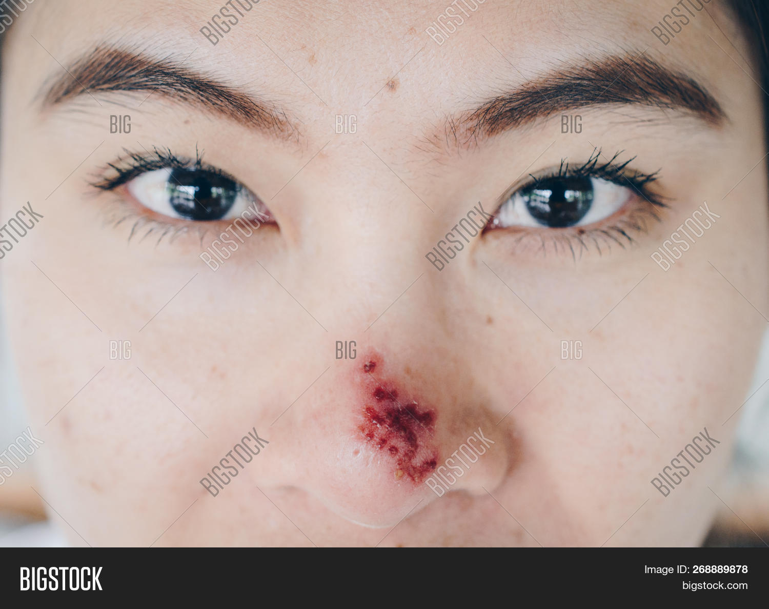Herpes Simplex On Image & Photo (Free Trial) Bigstock
