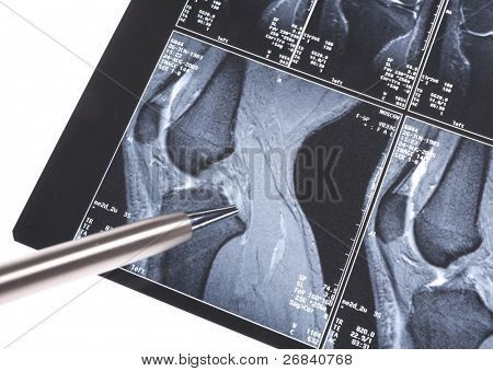 MRI - poškození vazů ve tvaru kříže