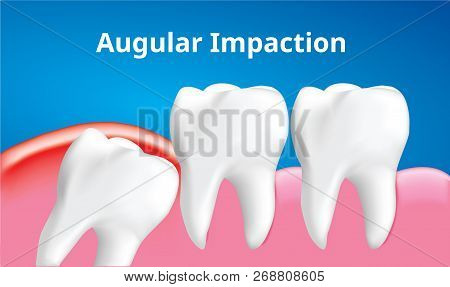 Wisdom Tooth ( Angular Or Mesial Impaction ) With Inflammation Affect , Dental Care Concept, Realist