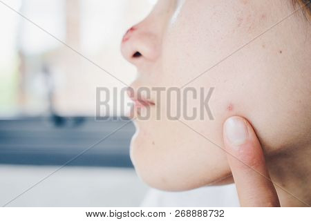 Asian Woman With The Problem On Her Skin, Herpes Simplex On Her Nose And Acne On Her Face Skin.