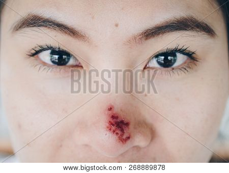 The Herpes Simplex On Asian Woman Nose, Herpes Simplex Is A Viral Disease Caused By The Herpes Simpl