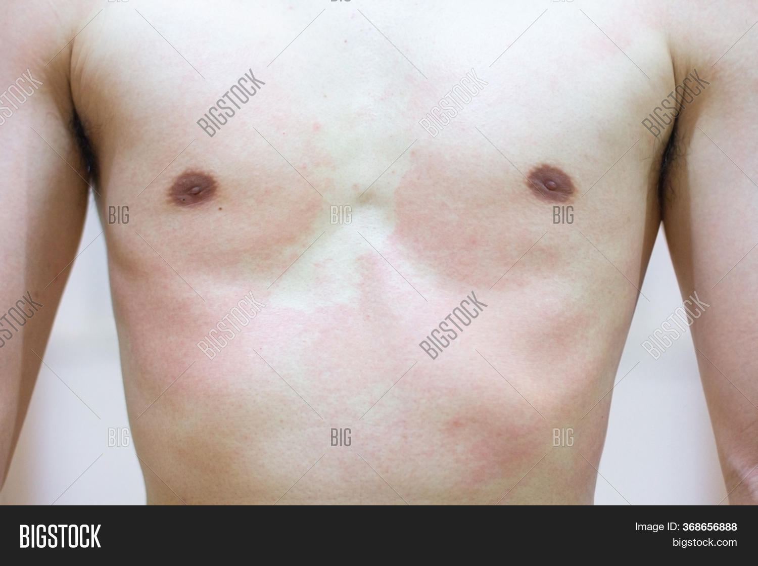 Skin Diseases. Man Image & Photo (Free Trial) | Bigstock