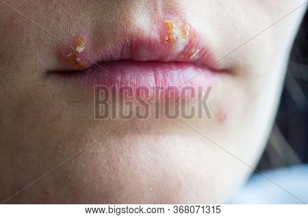Herpes Disease On The Lips Of A Young Girl. Wounds From Herpes On The Lips Of A Person. Herpes Foci.
