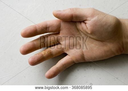 Closeup Of Eczema Dermatitis On Man Hand And Fingers. Skin Peeling,desquamation Of Hand, Gray Modern