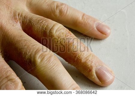 Closeup Of Eczema Dermatitis On Man Hand And Fingers. Skin Peeling,desquamation Of Hand, Gray Modern
