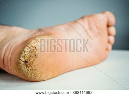 Cracked callosity male heel close-up