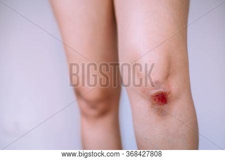 Woman Suffering From Bleeding Wound On Her Knee On White Blackground,scab Becomes Infected