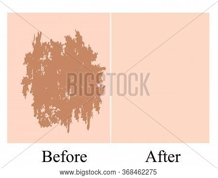 Pigmentation On The Skin Background. A Pigmented Spot On The Skin Of The Face. Before And After Trea