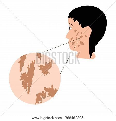 Pigmentation On The Skin. A Pigmented Spot On The Skin Of The Face. Illustration