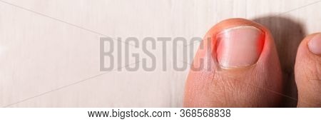 Ingrown Toenail Problem. Sore Nail And Painful Toe