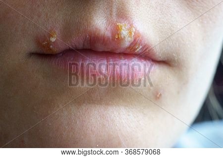 Herpes Disease On The Lips Of A Young Girl. Wounds From Herpes On The Lips Of A Person. Herpes Foci.