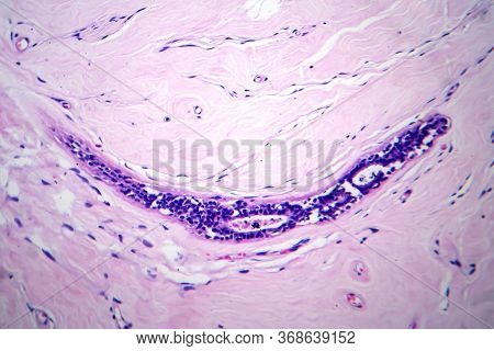 Uterus Adenofibroma, Light Micrograph, Photo Under Microscope. A Rare Benign Tumor Of The Uterus Com