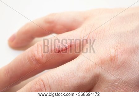 Hand Dermatitis. Hand Eczema Closed On White Background
