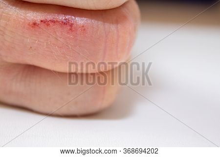Hand Dermatitis. Hand Eczema Closed On White Background