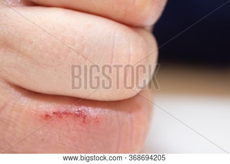 Hand Dermatitis. Hand Eczema Closed On White Background