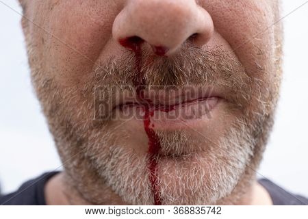 Nosebleed , A Man Is Bleeding From His Nose