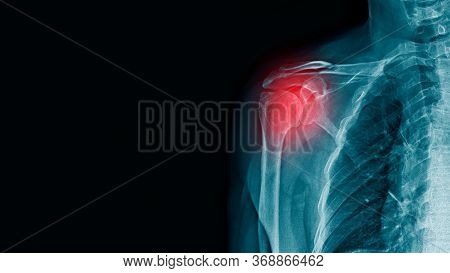 X-ray Image Of Shoulder