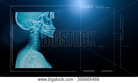 X-ray Cervical Spine