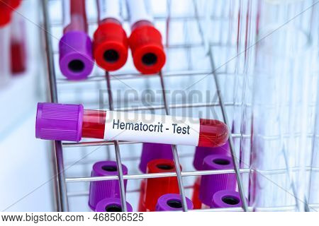 Hematocrit Test To Look For Abnormalities From Blood,  Blood Sample To Analyze In The Laboratory, Bl