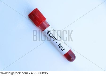 Sgpt Test To Look For Abnormalities From Blood,  Blood Sample To Analyze In The Laboratory, Blood In