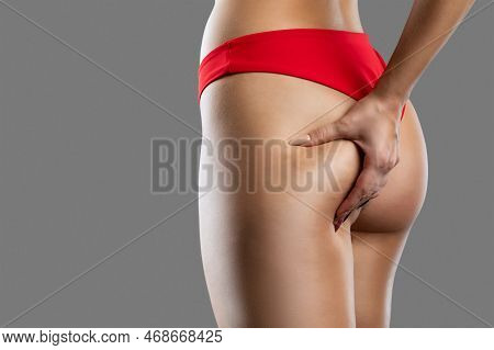 The Girl Stretches The Skin On Her Leg, Showing Fat Deposits And Cellulite. The Concept Of Weight Lo