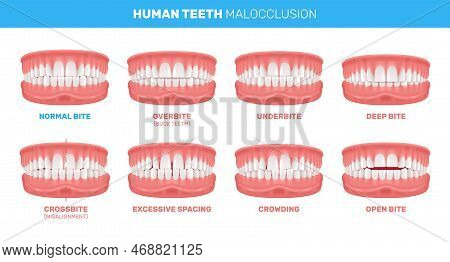 Human Teeth Malocclusion Set With Realistic Images Of Mouth Jaws With Crooked Teeth And Text Caption