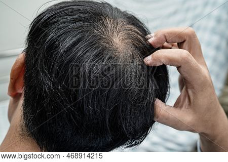 Bald In The Middle Head And Begin No Loss Hair Glabrous Of Mature Asian Business Smart Active Office