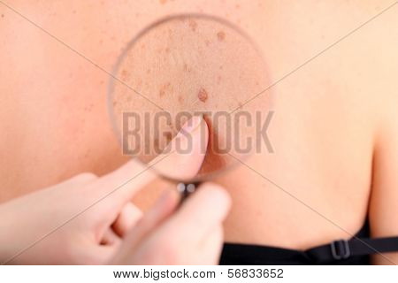 Dermatologist examines a birthmark of patient, close up