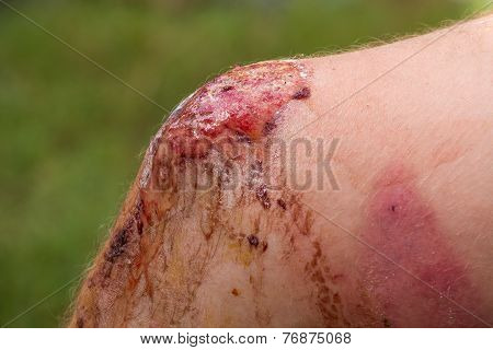 Wound On His Leg Man