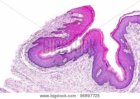 Skin papilloma of a human