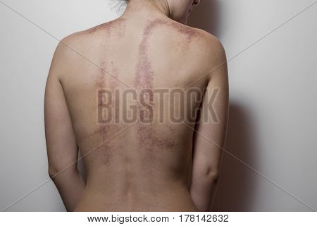 Rear View Of A Woman With Bruises On White Background.