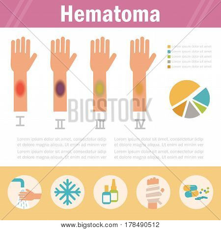 Hematoma. Stages. Isolated art on white background. Vector. Cartoon. Flat. For websites brochures magazines Medicine