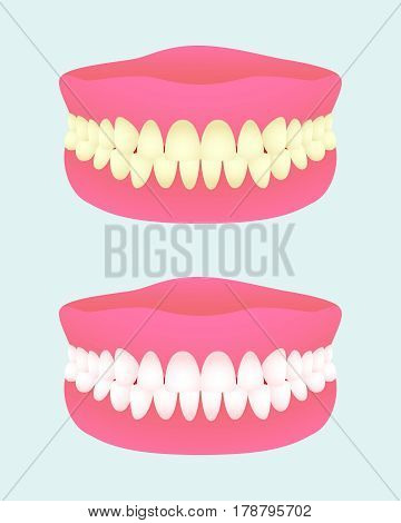 Denture in two health states. Dental implant with different teeth colors. Sick and healthy teeth jaw. Medical items. Vector illustration.