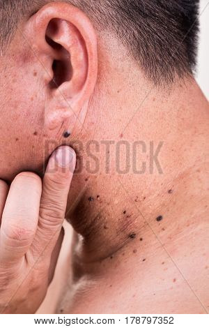 Finger Embrace Mole On Neck And Shoulder Of Asian Male