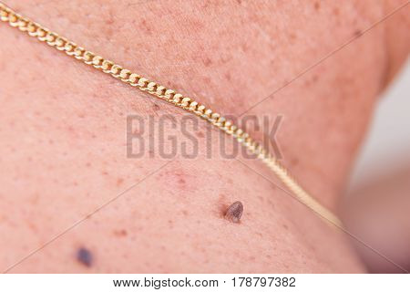 Closeup Of Elevated Mole On Shoulder Of Asian Man