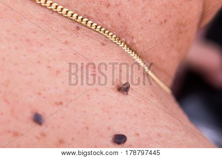 Closeup Of Elevated Mole On Shoulder Of Asian Man