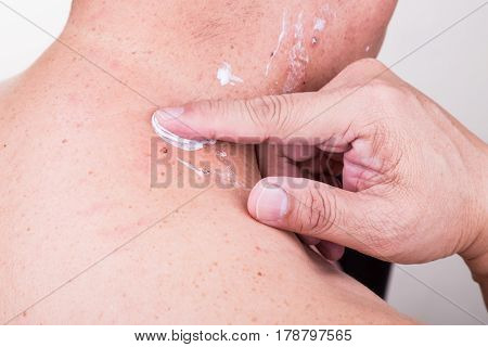 Man Applying Antibiotic Cream Onto Wound From Removed Mole