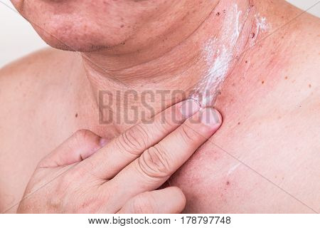 Man Applying Antibiotic Cream Onto Wound From Removed Mole