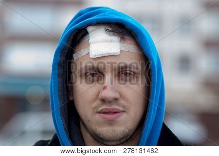 Suture Wound At Skull With Wires, Postoperative Stitching Craniectomy With Many Staples, Medical Sew